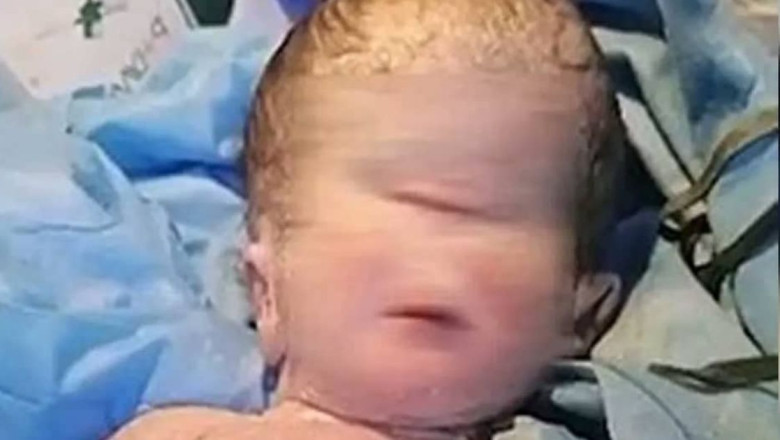 Baby With One Eye Is Born in Iraq; Pictures Go Viral